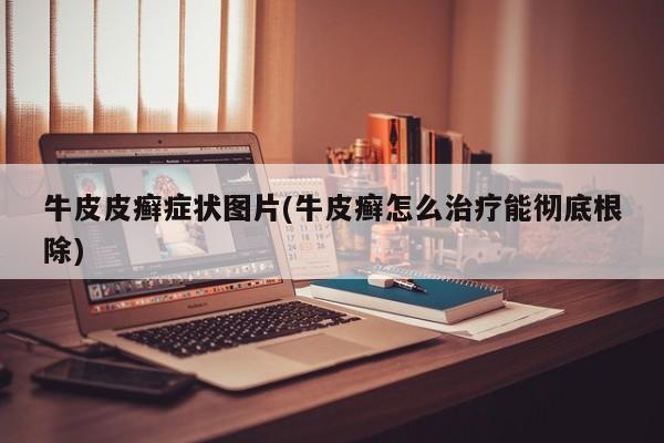 牛皮皮癣症状图片(牛皮癣怎么治疗能彻底根除)